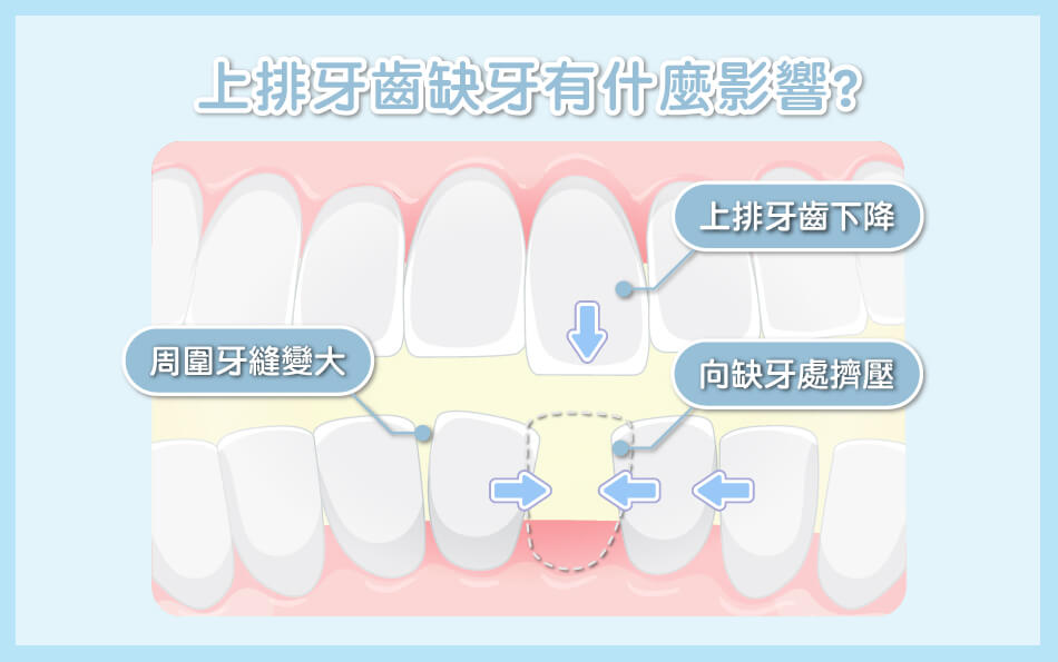 舒適美牙醫聯盟_「缺牙不重建」，可不是牙齦萎縮這麼簡單！