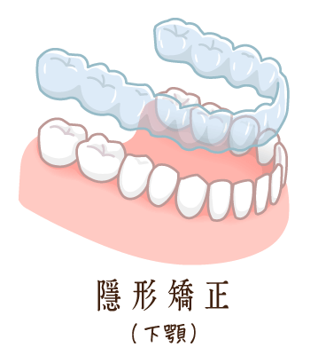 舒適美牙醫聯盟_隱形矯正下顎