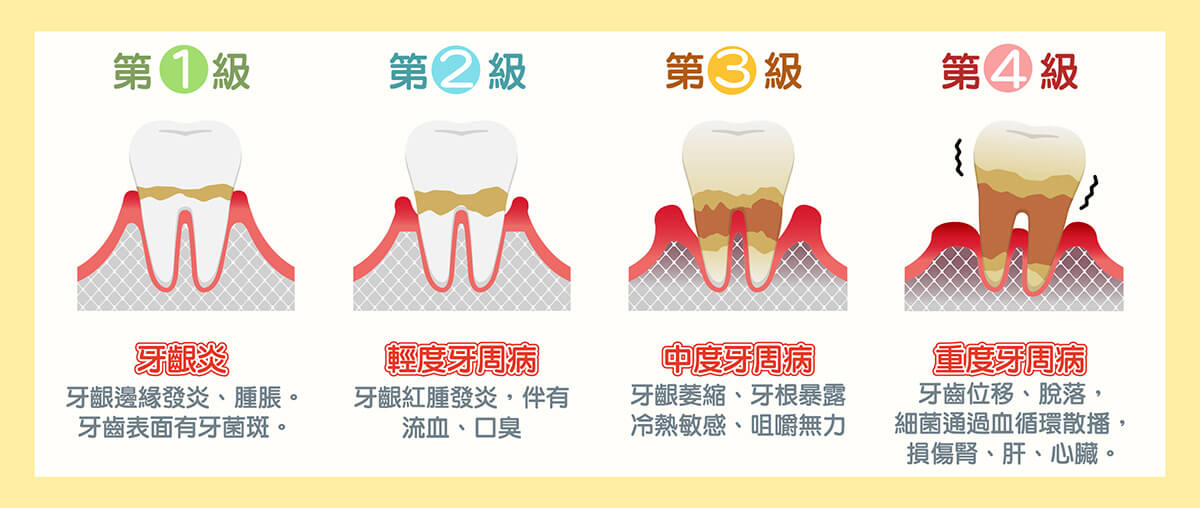 舒適美牙醫聯盟_牙周病治療