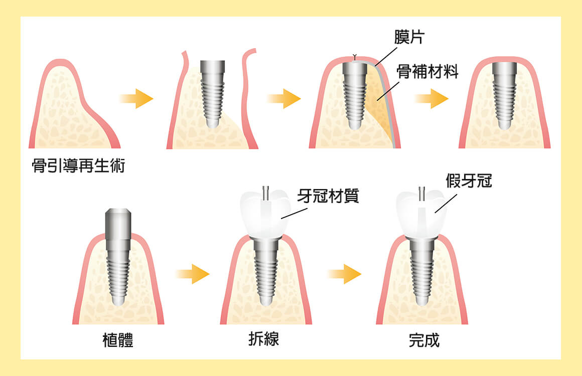 舒適美牙醫聯盟_骨引導再生術的優勢