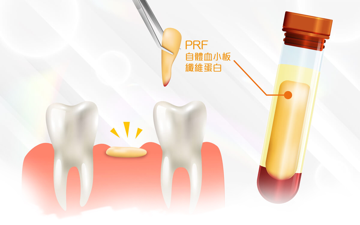 舒適美牙醫聯盟_PRF自體血小板纖維蛋白